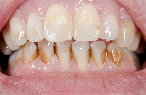 does honey stain teeth|does enamel stain teeth.